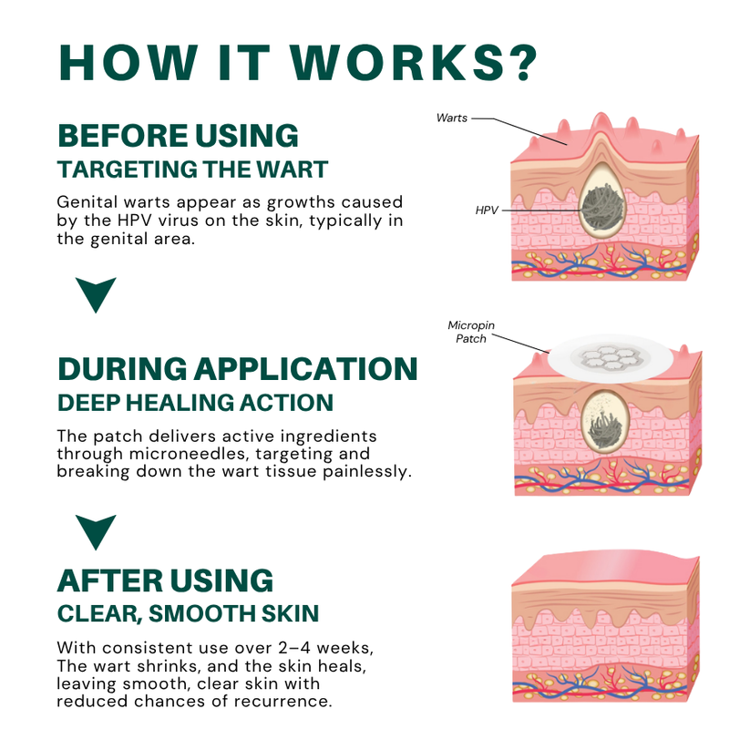 Juxek® Wart Removal Pain-Free, Clinically Proven Solution