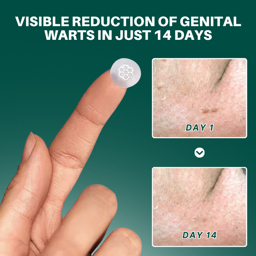 Juxek®  Wart Removal Pain-Free, Clinically Proven Solution