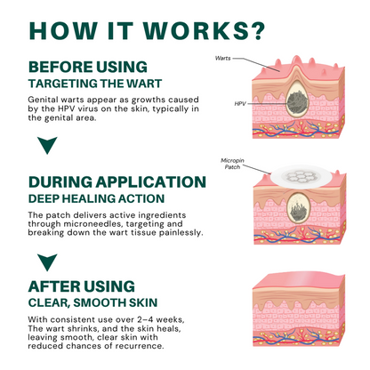 Juxek®  Wart Removal Pain-Free, Clinically Proven Solution