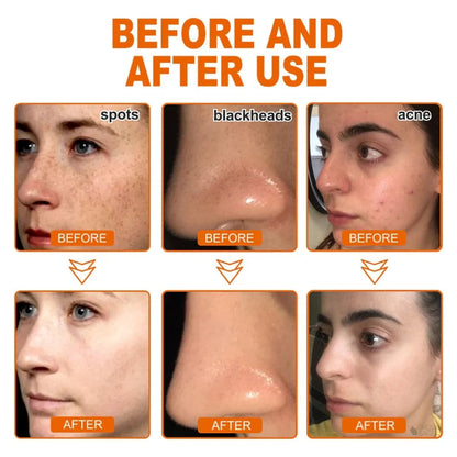 [Official Brand Store]BBOJI™Herbal Spots Peel-Off Facial Mask