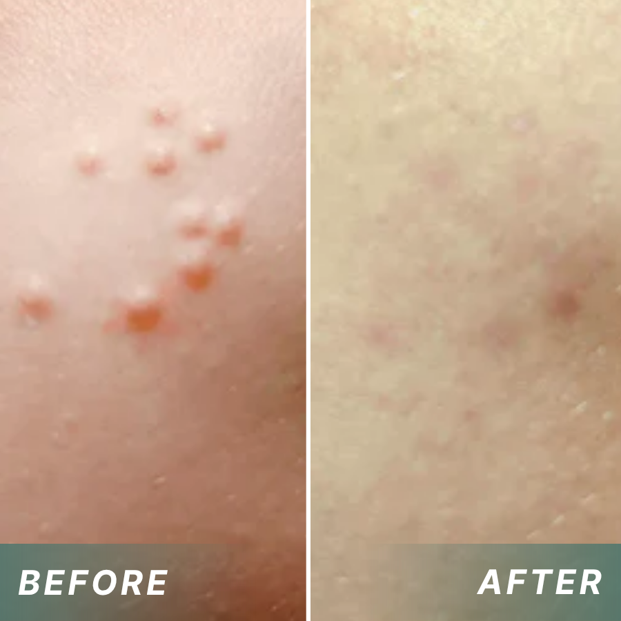 Juxek®  Wart Removal Pain-Free, Clinically Proven Solution