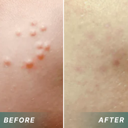 Juxek®  Wart Removal Pain-Free, Clinically Proven Solution